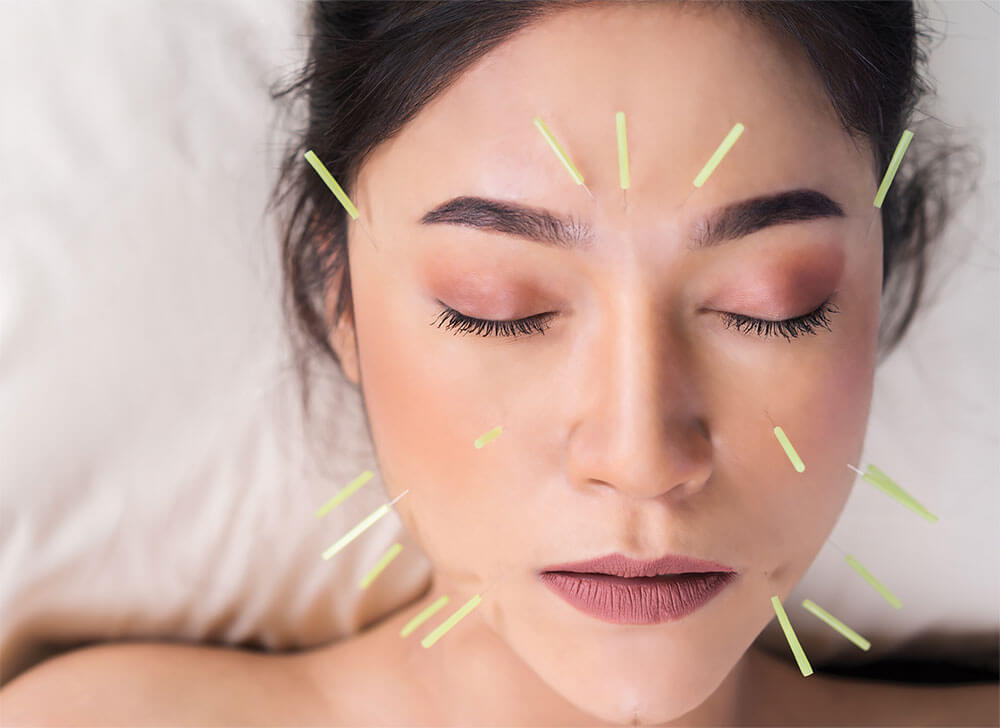 cosmetic-acupuncture-1